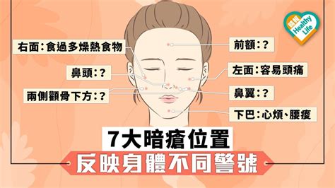 面生暗瘡|【暗瘡位置】不同代表什麼？中醫教如何處理及預防